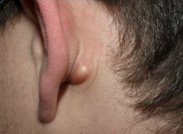 اسباب التهاب الغدد اللمفاوية خلف الاذن