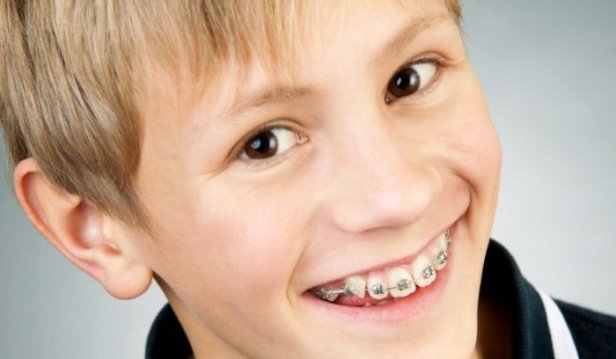 فوائد تركيب تقويم الاسنان للاطفال بوقت مبكر