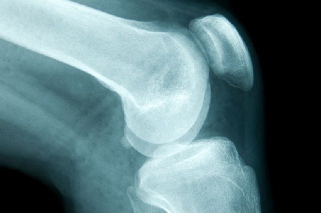 مخاطر ظهور الورم الغرني العظمي