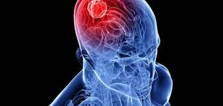 أعراض وعلاج الورم الأرومي في الدماغ