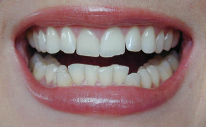 اضرار الاسنان الملتوية