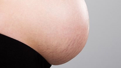 التغيرات الجلدية في الثلث الأخير من الحمل