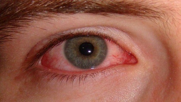 العلاجات المنزلية لحرقة العين من الحساسية