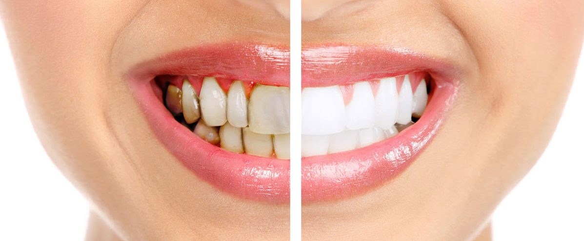 علاج تسوس الاسنان الامامية بالليزر بدون حفر