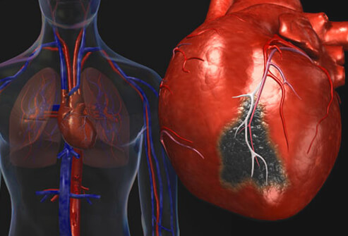 كيفية الوقاية من النوبات القلبية