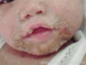 متلازمة الجلد المسموط العنقودية عند الأطفال