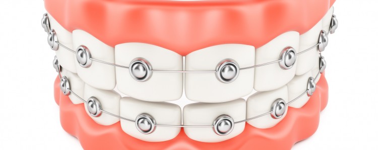 معلومات كاملة عن انواع تقويم الاسنان
