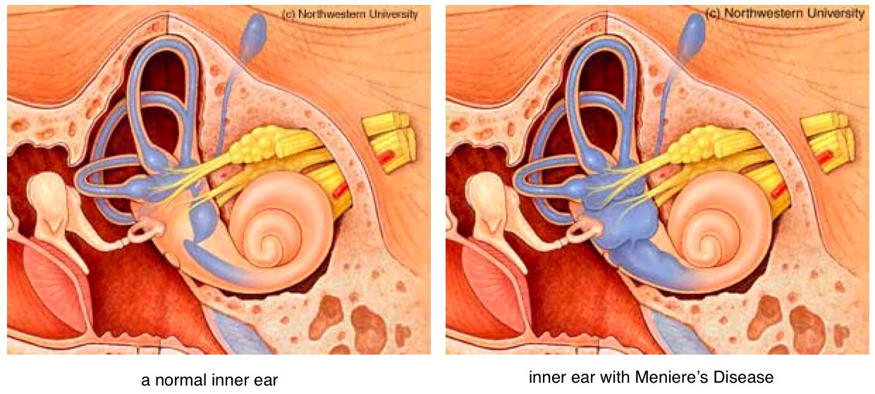 أضرار الإصابة بمرض مينيير على السمع والتوازن