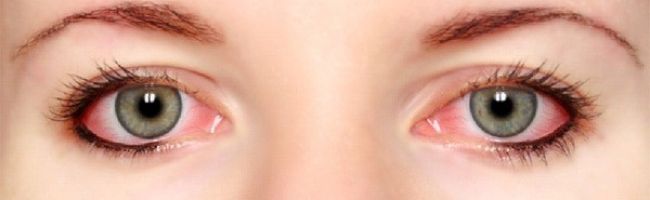 أعراض حساسية العين وعلاجها