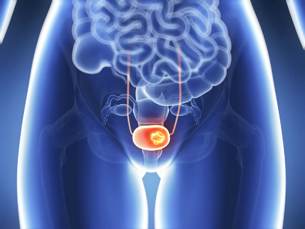 أعراض سرطان المثانة التي يجب أن تعرفها السيدات