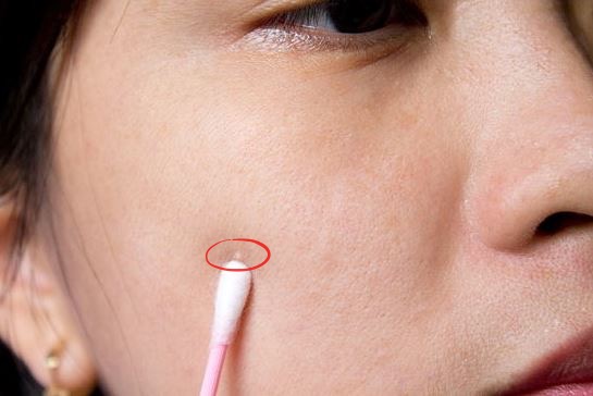 أفضل الطرق الطبيعية لعلاج النتوء الزيتية في الوجه
