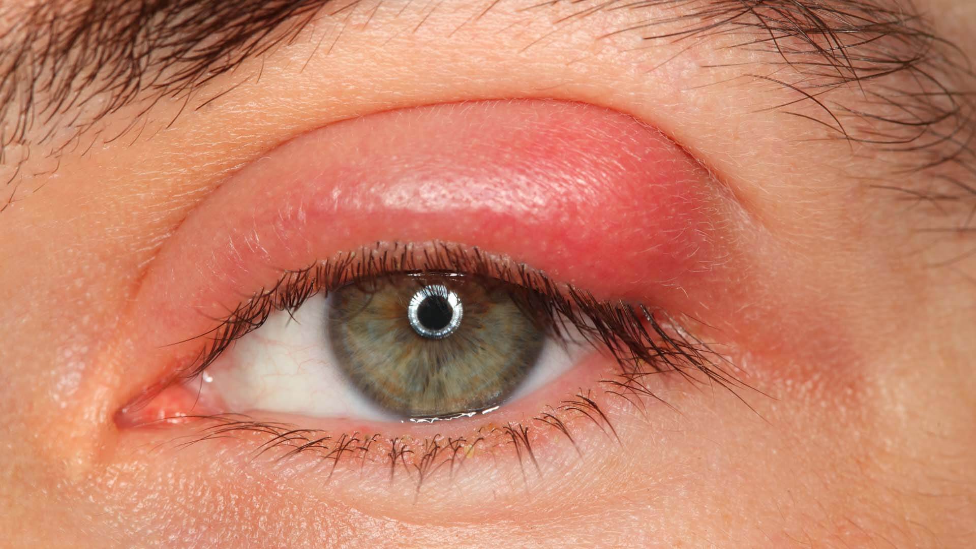 اضرار التهاب جفن العين