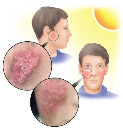 الادوية التي تسبب زيادة حساسية الجلد للشمس