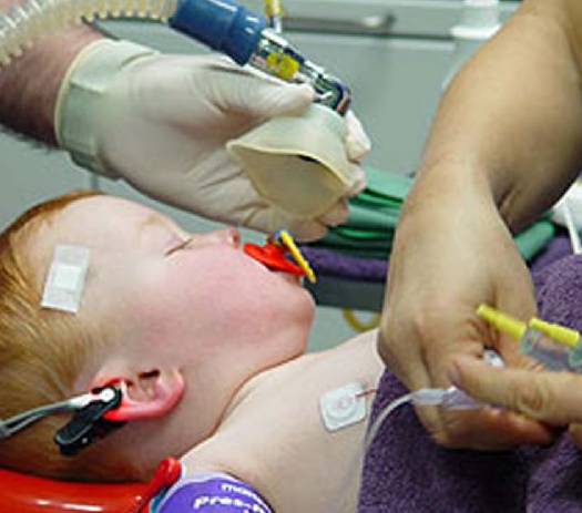 تأثير التخدير والبنج الكامل للـ الاطفال و الرضع
