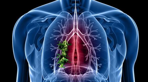دراسة حديثة تثبت أن العلاج الإشعاعي ليس مفيد لسرطان الرئة