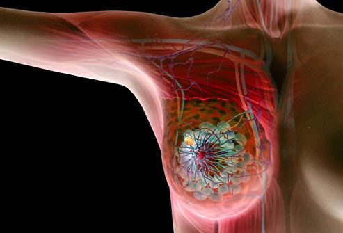 دراسة حديثة مضاعفة العلاج الهرموني البديل للإصابة بسرطان الثدي