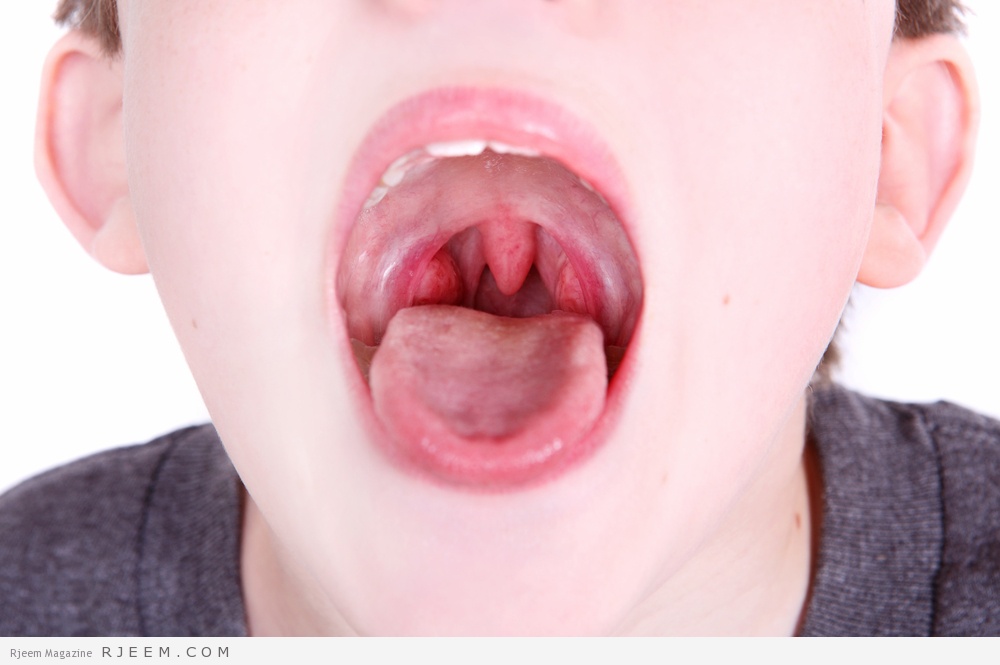 علاج التهاب اللوزتين لدى الأطفال