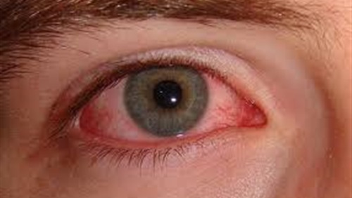 ما هو سرطان شبكية العين ؟