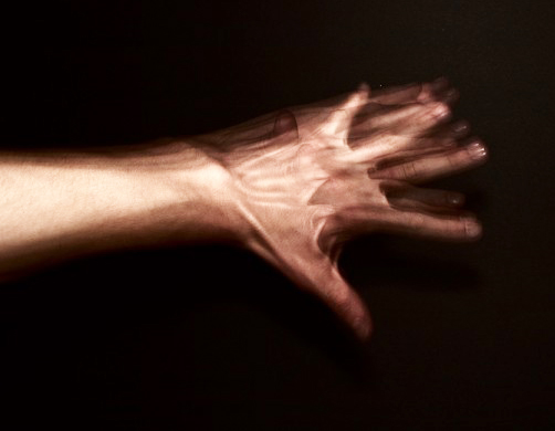 متلازمة اليد الغريبة ” أغرب الحالات المرضية في التاريخ “