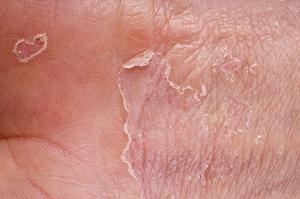 مخاطر التهاب الجلد التقشري