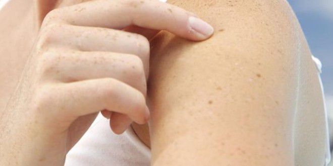 “11 شامة “على جلد يدك مؤشر على الأصابة بسرطان الجلد