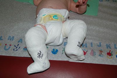 أسباب وعلاج القدم الحنفاء عند الأطفال