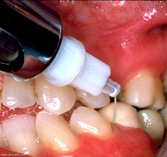 اضرار كثرة بنج الاسنان