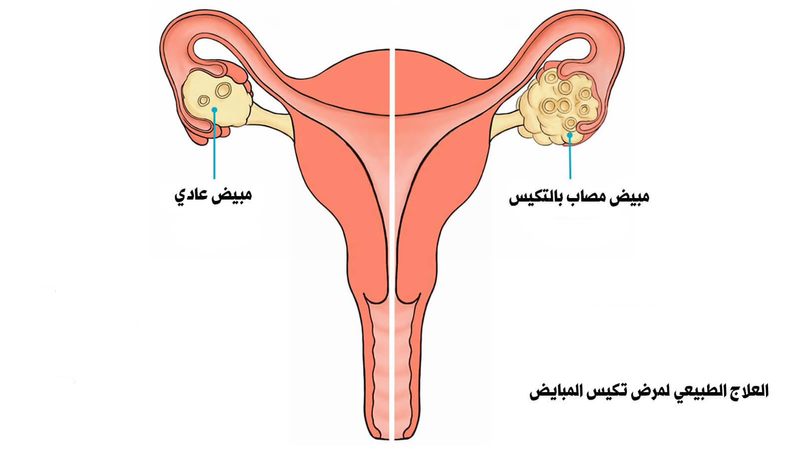 اعراض ارتفاع هرمون الذكورة عند النساء