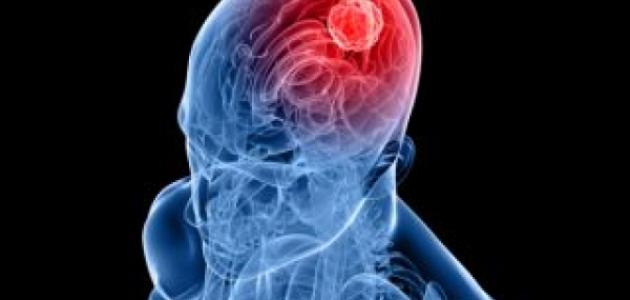 اعراض النزيف الداخلي في الرأس