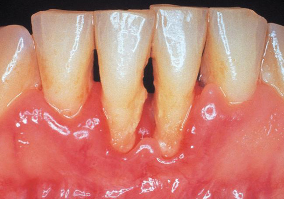 التهاب دواعم الأسنان وعلاجه