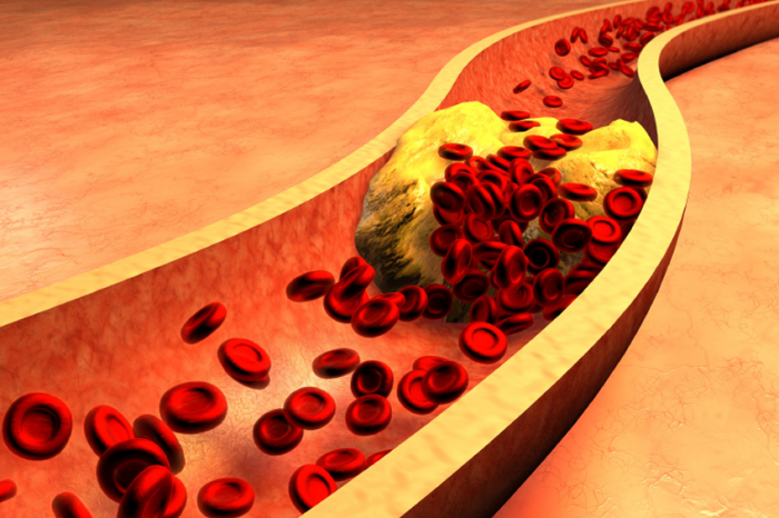 ما هو مرض فرط شحميات الدم ” Hyperlipidemia “