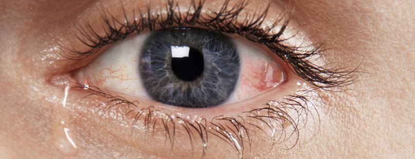 ما هي العيون الدامعة ؟ وماهو علاجها ؟