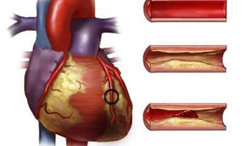 امراض القلب التاجية