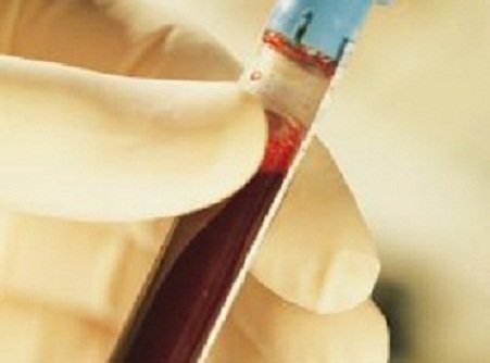 متلازمة انحلال الدم اليوريمي