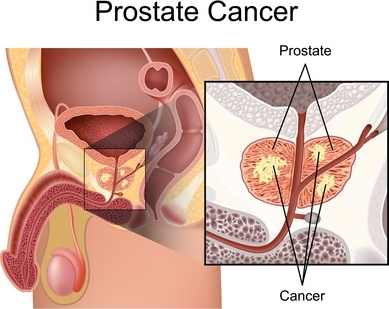 أحدث الدراسات والأبحاث الطبية عن سرطان البروستاتا