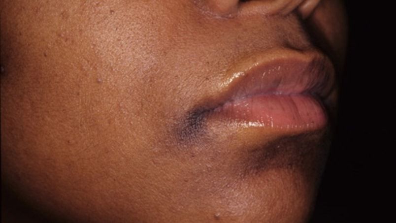 اسباب اسمرار منطقة ما حول الفم وعلاجها
