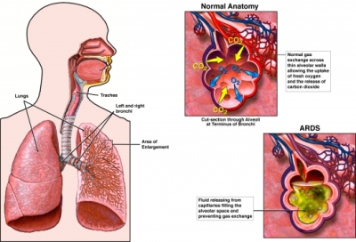 اسباب متلازمة الضائقة التنفسية