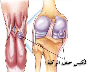 اسباب و علاج التهاب كيسي في الركبة