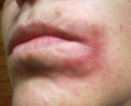 اسباب وعلاج الطفح الجلدي حول الفم
