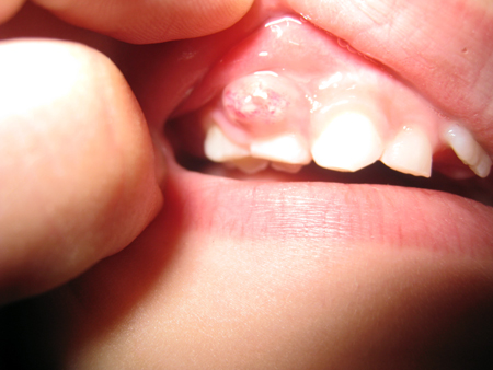 اعراض خراج الأسنان
