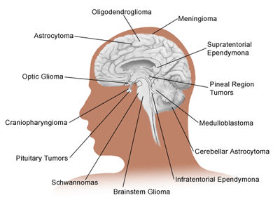 اعراض ورم المخ