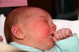 الحساسية عند الاطفال حديثي الولادة