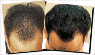 تقنية زراعة الشعر