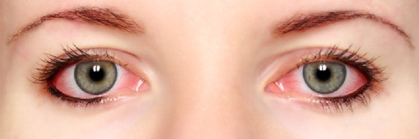 علاج احمرار العين في المنزل