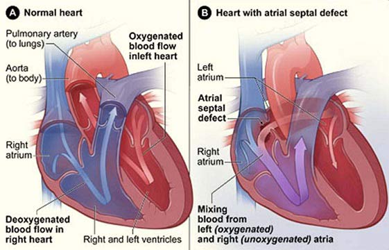 علاج ثقب القلب عند الاطفال