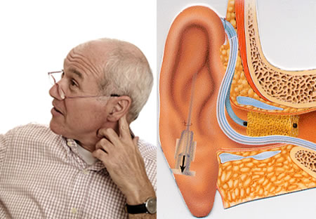 علاج ثقل السمع