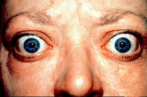 علاج مرض العين الدرقي