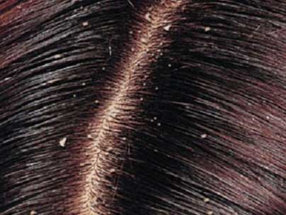 علاج قشرة الشعر بطرق طبيعية