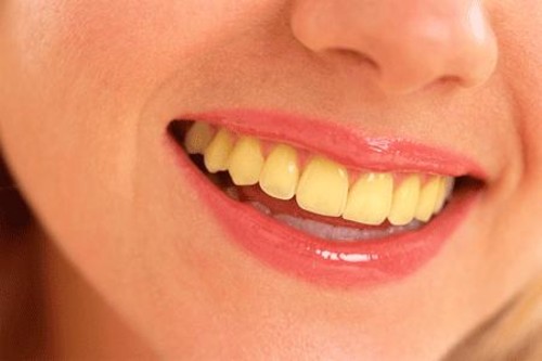 كيفية التخلص من الاسنان الصفراء