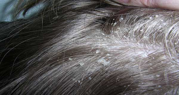 وصفات طبيعية للتخلص من قشرة الشعر نهائيا
